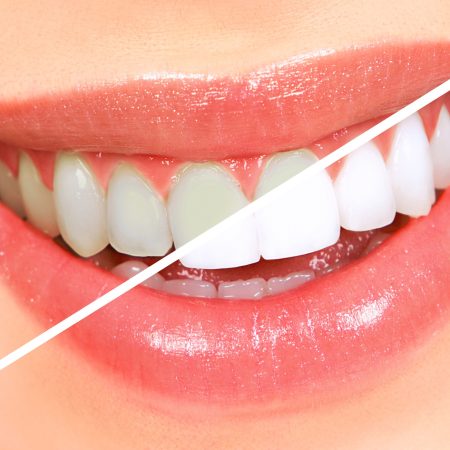 The Influence of Music on Teeth Whitening Success