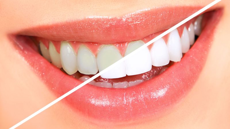 The Influence of Music on Teeth Whitening Success