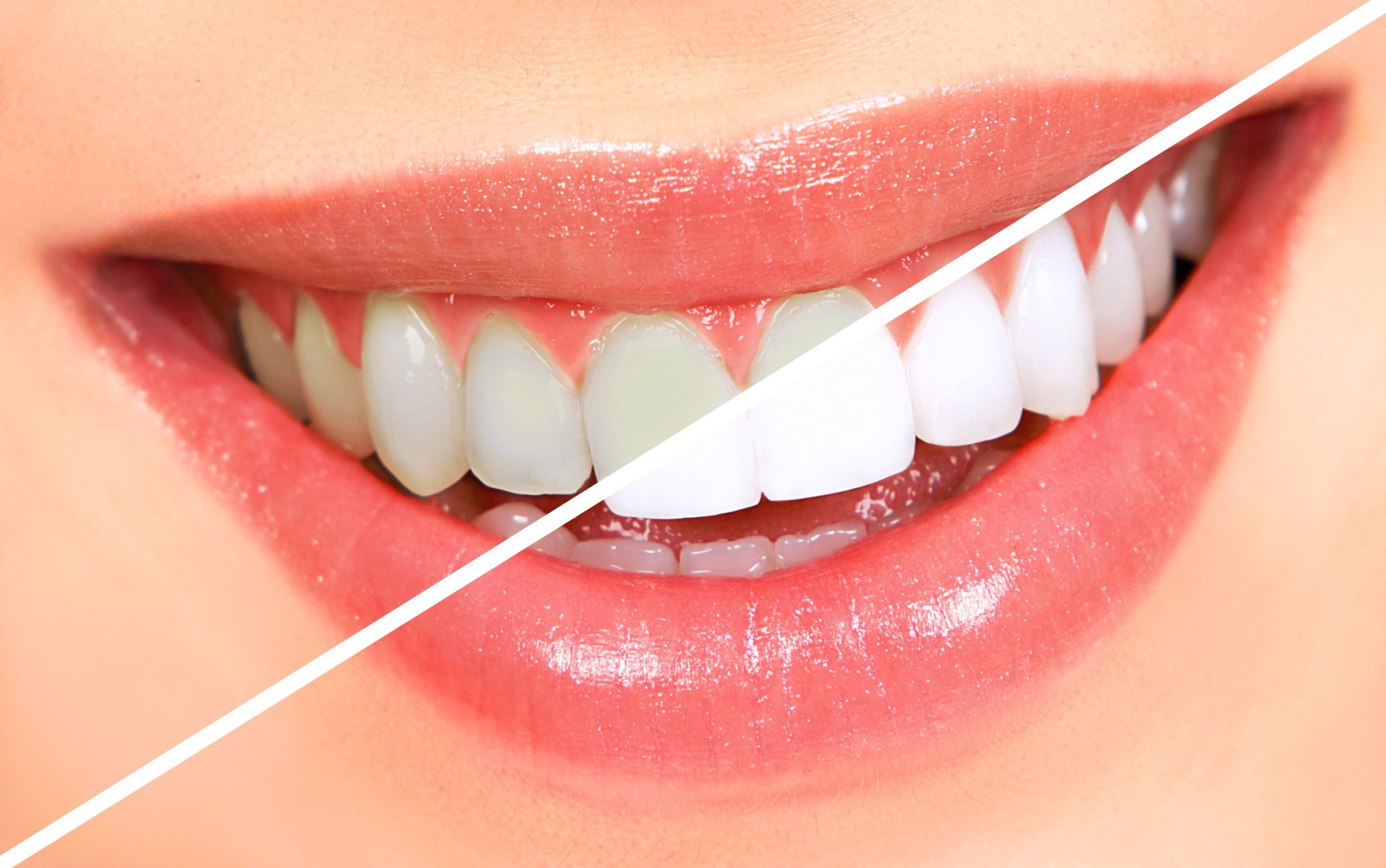 The Influence of Music on Teeth Whitening Success